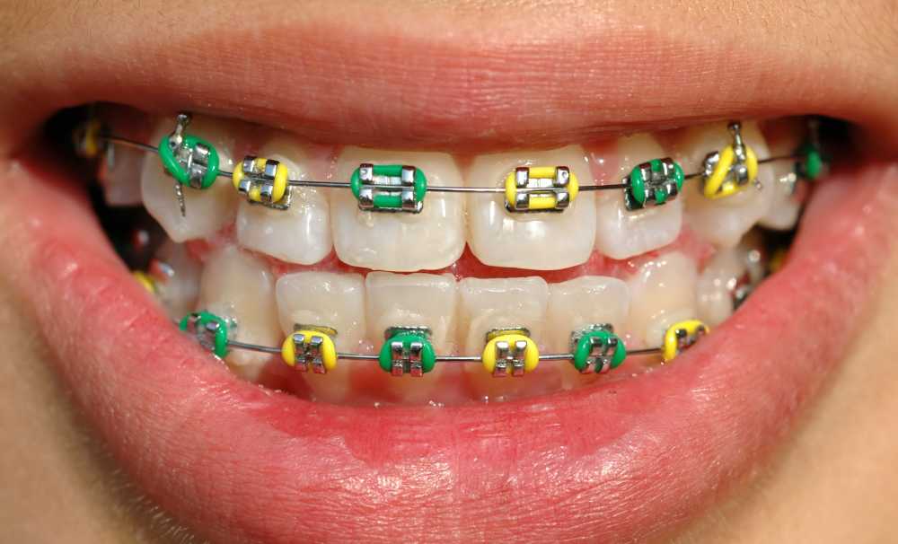 Çene problemlerinde erken müdahale çok önemli